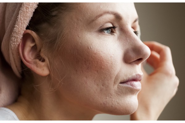 Tipos de cicatrizes de acne e como tratar: dermatologista explica