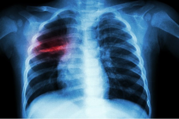 Conheça os principais sintomas e tratamentos da tuberculose