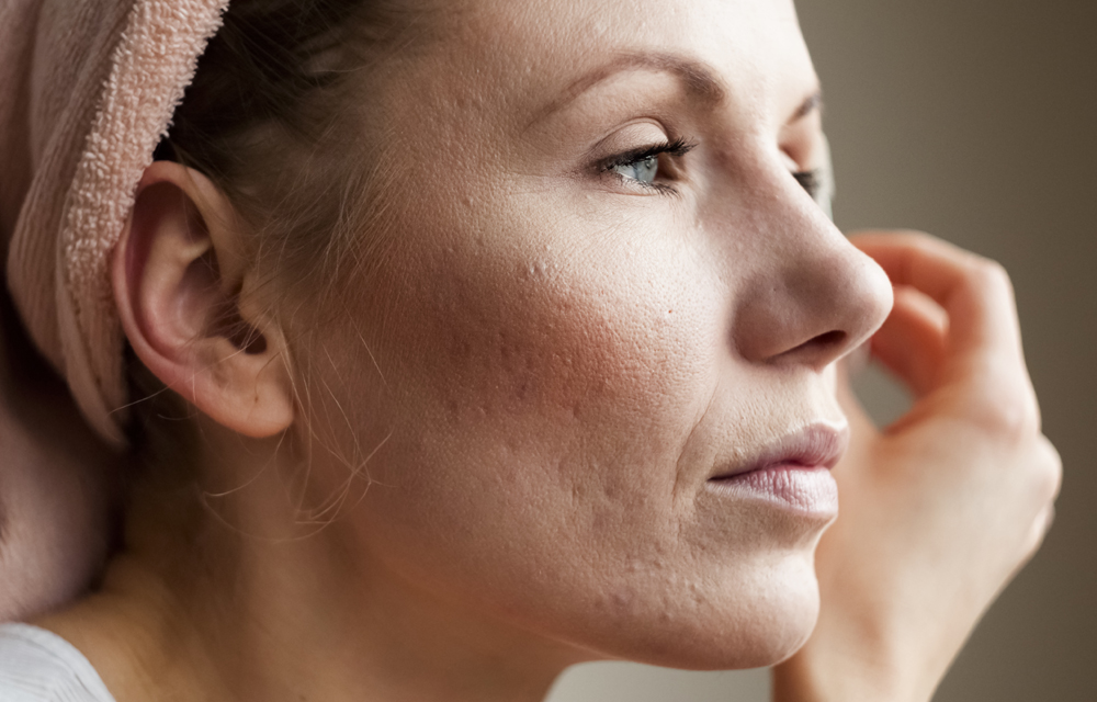Tipos de cicatrizes de acne e como tratar: dermatologista explica