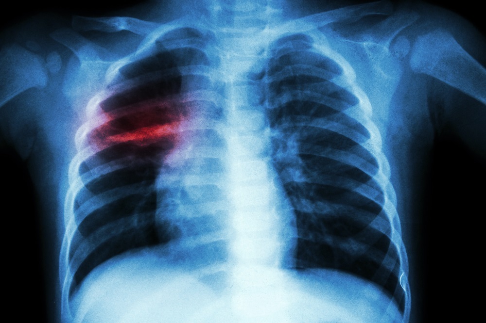 Conheça os principais sintomas e tratamentos da tuberculose